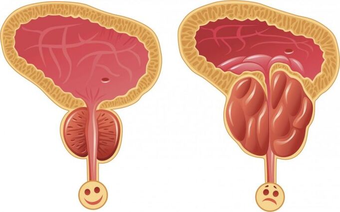 prostatitisarekin osasuntsu eta hanturazko prostata