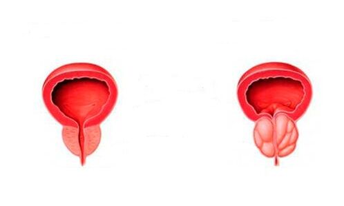 prostatitisarekin osasuntsu eta hanturazko prostata